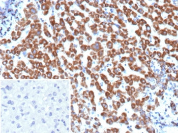 IHC staining of FFPE human hepatocellular carcinoma tissue with Angiopoietin 1 antibody (clone ANGPT1/3651). Inset: PBS used in place of primary Ab (secondary Ab negative control). HIER: boil tissue sections in pH 9 10mM Tris with 1mM EDTA for 20 min and allow to cool before testing.