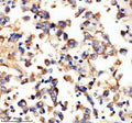 IHC staining of FFPE human testis cancer tissue with UPF1 antibody, HRP-secondary and DAB substrate. HIER: boil tissue sections in pH8 EDTA for 20 min and allow to cool before testing.