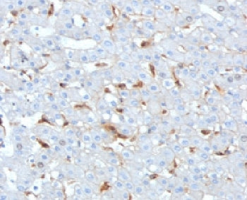 IHC staining of FFPE human hepatocellular carcinoma tissue with Complement C1q B-Chain antibody (clone C1QB/2962). HIER: boil tissue sections in pH 9 10mM Tris with 1mM EDTA for 20 min and allow to cool before testing.