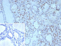 IHC staining of FFPE human thyroid tissue with NKX2.1 antibody (clone NX2.1/9030). Inset: PBS used in place of primary Ab (secondary Ab negative control). HIER: boil tissue sections in pH 9 10mM Tris with 1mM EDTA for 20 min and allow to cool before testing.