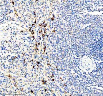 Immunohistochemical staining of IL21R using anti-IL21R antibody. IL21R was detected in a paraffin-embedded section of human prostate cancer tissue. Heat mediated antigen retrieval was performed in EDTA buffer (pH 8.0, epitope retrieval solution). The tissue section was blocked with 10% goat serum. The tissue section was then incubated with 2 ug/ml rabbit anti-IL21R antibody overnight at 4oC. Peroxidase Conjugated Goat Anti-rabbit IgG was used as secondary antibody and incubated for 30 min at 37oC.