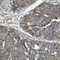 IHC staining of FFPE human urothelial carcinoma tissue with CXCR7 antibody. HIER: boil tissue sections in pH8 EDTA for 20 min and allow to cool before testing.