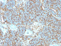 IHC staining of FFPE human Ewings sarcoma with recombinant CD99 antibody (clone rMIC2/3317). HIER: boil tissue sections in pH 9 10mM Tris with 1mM EDTA for 20 min and allow to cool before testing.