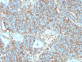 IHC staining of FFPE human Ewings sarcoma with recombinant CD99 antibody (clone rMIC2/3317). HIER: boil tissue sections in pH 9 10mM Tris with 1mM EDTA for 20 min and allow to cool before testing.