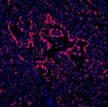 Immunofluorescent staining of FFPE human intestinal cancer with DDX5 antibody (red) and DAPI nuclear stain (blue). HIER: steam section in pH8 EDTA for 20 min.