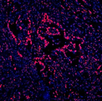 Immunofluorescent staining of FFPE human intestinal cancer with DDX5 antibody (red) and DAPI nuclear stain (blue). HIER: steam section in pH8 EDTA for 20 min.