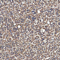 IHC staining of FFPE human liver cancer tissue with SH2D4A antibody. HIER: boil tissue sections in pH8 EDTA for 20 min and allow to cool before testing.
