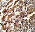 IHC testing of FFPE human hepatocellular carcinoma tissue with Endoplasmic reticulum resident protein 29 antibody. HIER: steam section in pH6 citrate buffer for 20 min and allow to cool prior to staining.