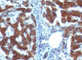 IHC testing of FFPE human hepatocellular carcinoma with RBP (clone RLBD1). Staining of formalin-fixed tissues requires boiling tissue sections in pH 9 10mM Tris with 1mM EDTA for 10-20 min followed by cooling at RT for 20 min.