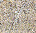 Immunohistochemical staining of CYP26B1 using anti-CYP26B1 antibody. CYP26B1 was detected in a paraffin-embedded section of human thyroid cancer tissue. Heat mediated antigen retrieval was performed in EDTA buffer (pH 8.0, epitope retrieval solution). The tissue section was blocked with 10% goat serum. The tissue section was then incubated with 2 ug/ml rabbit anti-CYP26B1 antibody overnight at 4oC. Peroxidase Conjugated Goat Anti-rabbit IgG was used as secondary antibody and incubated for 30 min at 37oC.
