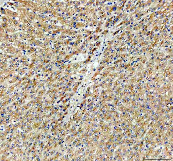 Immunohistochemical staining of CYP26B1 using anti-CYP26B1 antibody. CYP26B1 was detected in a paraffin-embedded section of human thyroid cancer tissue. Heat mediated antigen retrieval was performed in EDTA buffer (pH 8.0, epitope retrieval solution). The tissue section was blocked with 10% goat serum. The tissue section was then incubated with 2 ug/ml rabbit anti-CYP26B1 antibody overnight at 4oC. Peroxidase Conjugated Goat Anti-rabbit IgG was used as secondary antibody and incubated for 30 min at 37oC.