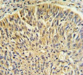 IHC testing of FFPE human lung carcinoma tissue with TCP1 gamma antibody. HIER: steam section in pH6 citrate buffer for 20 min and allow to cool prior to staining.