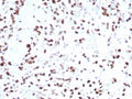 IHC staining of FFPE human bladder tissue with MDM2 antibody (clone MDM2/7943). HIER: boil tissue sections in pH 9 10mM Tris with 1mM EDTA for 20 min and allow to cool before testing.