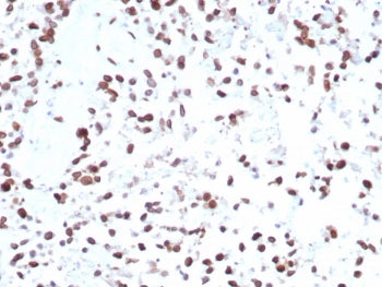 IHC staining of FFPE human bladder tissue with MDM2 antibody (clone MDM2/7943). HIER: boil tissue sections in pH 9 10mM Tris with 1mM EDTA for 20 min and allow to cool before testing.