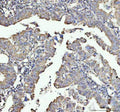 Immunohistochemical staining of NDUFAB1 using anti-NDUFAB1 antibody. NDUFAB1 was detected in a paraffin-embedded section of human thyroid cancer tissue. Heat mediated antigen retrieval was performed in EDTA buffer (pH 8.0, epitope retrieval solution). The tissue section was blocked with 10% goat serum. The tissue section was then incubated with 1:50 rabbit anti-NDUFAB1 antibody overnight at 4oC. Peroxidase Conjugated Goat Anti-rabbit IgG was used as secondary antibody and incubated for 30 min at 37oC.