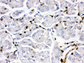 IHC testing of FFPE human pancreatic cancer tissue with Fos B antibody. HIER: Boil the paraffin sections in pH 6, 10mM citrate buffer for 20 minutes and allow to cool prior to staining.