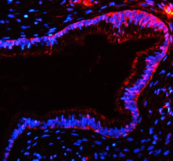 Immunofluorescent staining of TAS2R10 using anti-TAS2R10 antibody (red). TAS2R10 was detected in a paraffin-embedded section of human cervix cancer tissue. Heat mediated antigen retrieval was performed in EDTA buffer (pH 8.0, epitope retrieval solution). The tissue section was blocked with 10% goat serum. The tissue section was then incubated with 5 ug/ml rabbit anti-TAS2R10 antibody overnight at 4oC.