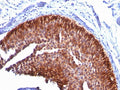 IHC: Formalin-fixed, paraffin-embedded human bladder carcinoma stained with Cytokeratin 17 antibody (KRT17/778).