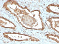 IHC staining of FFPE human prostate tissue with MIF antibody (clone MIF/6277). HIER: boil tissue sections in pH 9 10mM Tris with 1mM EDTA for 20 min and allow to cool before testing.