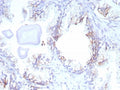 IHC staining of FFPE human prostate cancer tissue with MRP4 antibody (clone ABCC4/9179). HIER: boil tissue sections in pH 9 10mM Tris with 1mM EDTA for 20 min and allow to cool before testing.