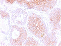IHC testing of FFPE human prostate carcinoma with CD44v3 antibody (clone CDLA44v3-1). Required HIER: steam sections in pH6 citrate buffer for 10-20 min and allow to cool before testing.