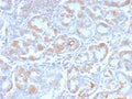 IHC staining of FFPE human stomach carcinoma with recombinant pS2 antibody (clone TFF1/2969R). HIER: boil tissue sections in pH6, 10mM citrate buffer, for 10-20 min and allow to cool before testing.