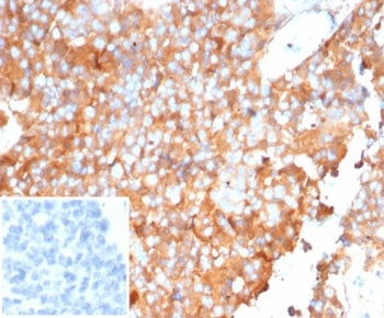IHC staining of FFPE human ovarian carcinoma tissue with SERPINA1 antibody (clone AAT/6323). Inset: PBS used in place of primary Ab (secondary Ab negative control). HIER: boil tissue sections in pH 9 10mM Tris with 1mM EDTA for 20 min and allow to cool before testing.