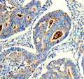 IHC staining of FFPE human colon cancer tissue with CHMP2B antibody, HRP-secondary and DAB substrate. HIER: boil tissue sections in pH8 EDTA for 20 min and allow to cool before testing.