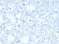 IHC staining of FFPE human breast with Estrogen Receptor beta 5 antibody (clone PPG5/25). HIER: boil tissue sections in pH 9 10mM Tris with 1mM EDTA for 20 min and allow to cool before testing.