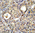 IHC analysis of TOP1MT using anti-TOP1MT antibody. TOP1MT was detected in a paraffin-embedded section of human liver cancer tissue. Heat mediated antigen retrieval was performed in EDTA buffer (pH 8.0, epitope retrieval solution). The tissue section was blocked with 10% goat serum. The tissue section was then incubated with 2 ug/ml rabbit anti-TOP1MT antibody overnight at 4oC. Peroxidase Conjugated Goat Anti-rabbit IgG was used as secondary antibody and incubated for 30 min at 37oC.