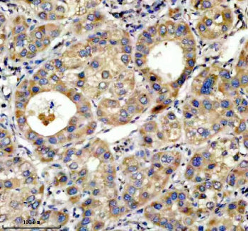 IHC analysis of TOP1MT using anti-TOP1MT antibody. TOP1MT was detected in a paraffin-embedded section of human liver cancer tissue. Heat mediated antigen retrieval was performed in EDTA buffer (pH 8.0, epitope retrieval solution). The tissue section was blocked with 10% goat serum. The tissue section was then incubated with 2 ug/ml rabbit anti-TOP1MT antibody overnight at 4oC. Peroxidase Conjugated Goat Anti-rabbit IgG was used as secondary antibody and incubated for 30 min at 37oC.