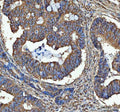 Immunohistochemical staining of SEC61G using anti-SEC61G antibody. SEC61G was detected in a paraffin-embedded section of human ovarian cancer tissue. Heat mediated antigen retrieval was performed in EDTA buffer (pH 8.0, epitope retrieval solution). The tissue section was blocked with 10% goat serum. The tissue section was then incubated with 2 ug/ml rabbit anti-SEC61G antibody overnight at 4oC. Peroxidase Conjugated Goat Anti-rabbit IgG was used as secondary antibody and incubated for 30 min at 37oC.