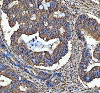 Immunohistochemical staining of SEC61G using anti-SEC61G antibody. SEC61G was detected in a paraffin-embedded section of human ovarian cancer tissue. Heat mediated antigen retrieval was performed in EDTA buffer (pH 8.0, epitope retrieval solution). The tissue section was blocked with 10% goat serum. The tissue section was then incubated with 2 ug/ml rabbit anti-SEC61G antibody overnight at 4oC. Peroxidase Conjugated Goat Anti-rabbit IgG was used as secondary antibody and incubated for 30 min at 37oC.