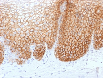 IHC testing of FFPE human cervical carcinoma with recombinant CD44v9 antibody (clone rCD44v9/1459). Required HIER: boil tissue sections in pH 9 10mM Tris with 1mM EDTA for 10-20 min followed by cooling at RT for 20 min.