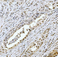 IHC staining of FFPE human appendiceal adenocarcinoma tissue with Meiotic recombination 11 antibody. HIER: boil tissue sections in pH8 EDTA for 20 min and allow to cool before testing.