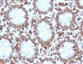 IHC testing of FFPE human colon carcinoma with CDX2 antibody (clone CTHP2-1). HIER: boil sections in pH 9 10mM Tris with 1mM EDTA for 10-20 min.