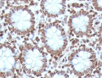 IHC testing of FFPE human colon carcinoma with CDX2 antibody (clone CTHP2-1). HIER: boil sections in pH 9 10mM Tris with 1mM EDTA for 10-20 min.