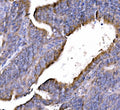 IHC staining of FFPE human rectal cancer tissue with GGA3 antibody. HIER: boil tissue sections in pH8 EDTA for 20 min and allow to cool before testing.