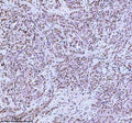 Immunohistochemical staining of MED4 using anti-MED4 antibody. MED4 was detected in a paraffin-embedded section of human rectum adenocarcinoma tissue. Heat mediated antigen retrieval was performed in EDTA buffer (pH 8.0, epitope retrieval solution). The tissue section was blocked with 10% goat serum. The tissue section was then incubated with 2 ug/ml rabbit anti-MED4 antibody overnight at 4oC. Peroxidase Conjugated Goat Anti-rabbit IgG was used as secondary antibody and incubated for 30 min at 37oC.
