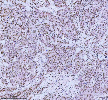 Immunohistochemical staining of MED4 using anti-MED4 antibody. MED4 was detected in a paraffin-embedded section of human rectum adenocarcinoma tissue. Heat mediated antigen retrieval was performed in EDTA buffer (pH 8.0, epitope retrieval solution). The tissue section was blocked with 10% goat serum. The tissue section was then incubated with 2 ug/ml rabbit anti-MED4 antibody overnight at 4oC. Peroxidase Conjugated Goat Anti-rabbit IgG was used as secondary antibody and incubated for 30 min at 37oC.