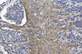 IHC staining of FFPE human gastric cancer with CRYAB antibody. HIER: boil tissue sections in pH8 EDTA for 20 min and allow to cool before testing.