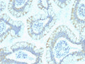 IHC staining of FFPE human colon carcinoma with SMAD4 antibody (clone SPM448). HIER: boil tissue sections in pH 9 10mM Tris with 1mM EDTA for 20 min and allow to cool before testing.