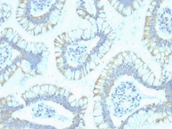 IHC staining of FFPE human colon carcinoma with SMAD4 antibody (clone SPM448). HIER: boil tissue sections in pH 9 10mM Tris with 1mM EDTA for 20 min and allow to cool before testing.