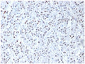 IHC staining of FFPE human mesothelioma with WT1 antibody. HIER: boil tissue sections in pH 9 10mM Tris with 1mM EDTA for 20 min and allow to cool before testing.