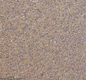 Immunohistochemical staining of TRIM2 using anti-TRIM2 antibody. TRIM2 was detected in a paraffin-embedded section of human glioblastoma tissue. Heat mediated antigen retrieval was performed in EDTA buffer (pH 8.0, epitope retrieval solution). The tissue section was blocked with 10% goat serum. The tissue section was then incubated with 2 ug/ml rabbit anti-TRIM2 antibody overnight at 4oC. Peroxidase Conjugated Goat Anti-rabbit IgG was used as secondary antibody and incubated for 30 min at 37oC.