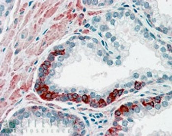 IHC staining of FFPE human prostate with ADAM12 antibody at 4ug/ml. HIER: steamed with pH6 citrate buffer, AP-staining.
