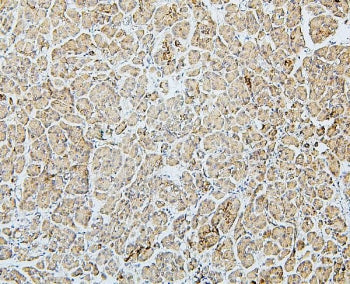 IHC staining of FFPE human pancreatic cancer with MTR antibody. HIER: boil tissue sections in pH6, 10mM citrate buffer, for 20 min and allow to cool before testing.