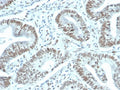 IHC staining of FFPE human prostate carcinoma tissue with recombinant FOXP1 antibody (clone FOXP1/44R) at 1ug/ml. HIER: boil tissue sections in pH 9 10mM Tris with 1mM EDTA for 20 min and allow to cool before testing.