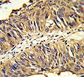 IHC testing of FFPE human lung carcinoma tissue with PDIA3 antibody. HIER: steam section in pH6 citrate buffer for 20 min and allow to cool prior to staining.