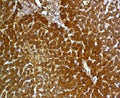 IHC: Formalin-fixed, paraffin-embedded human hepatocellular carcinoma stained with Glypican-3 antibody (GPC3/863)